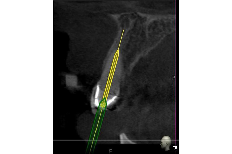 Navigált endodoncia (gyökérkezelés)